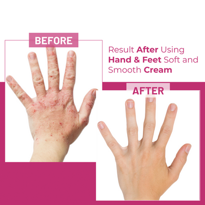 Hand and Feet  Whitening Cream